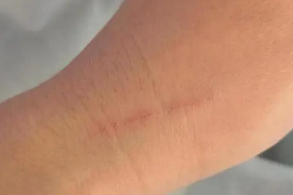 被打过针的猫抓伤出血要打针吗，不会携带狂犬病毒可不打针