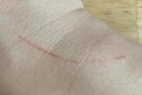 被打过针的猫抓伤出血要打针吗，不会携带狂犬病毒可不打针