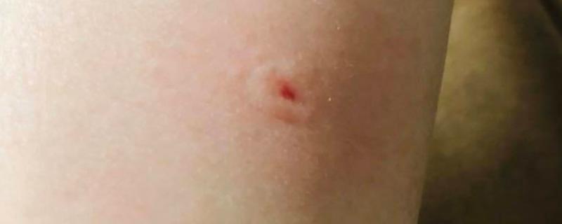 被蜜蜂蜇了怎么办