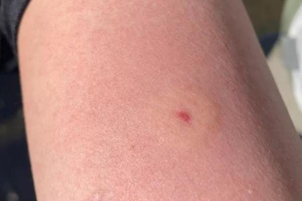 被蜜蜂蜇了怎么办,需取出毒针并用碱性溶液清洗伤处