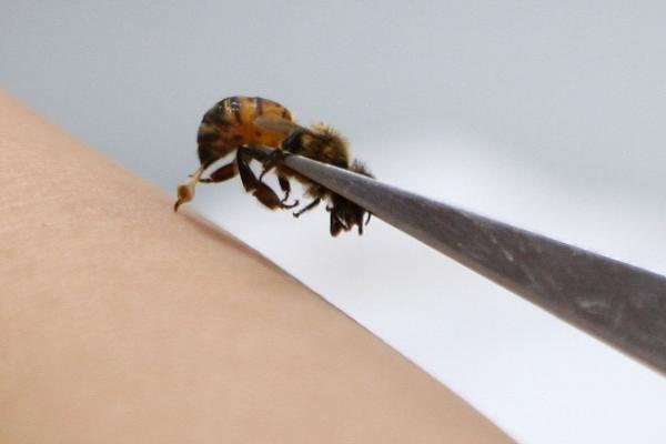 被蜜蜂蜇了怎么办,需取出毒针并用碱性溶液清洗伤处