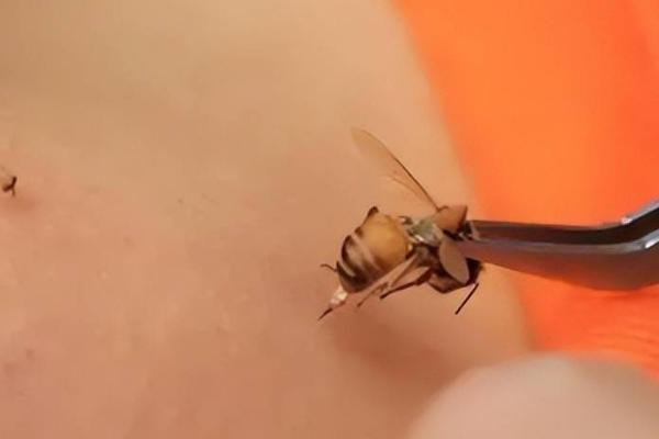 被蜜蜂蜇了怎么办,需取出毒针并用碱性溶液清洗伤处